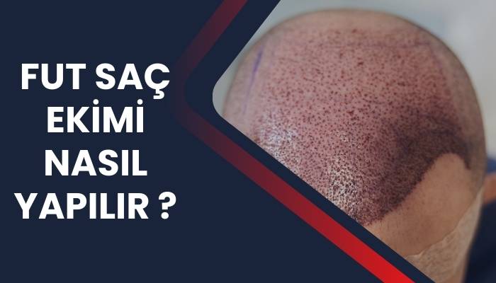 FUT Saç Ekimi Nasıl Yapılır