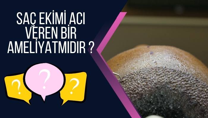 Saç Ekimi Acı Veren Bir Ameliyatmıdır ?