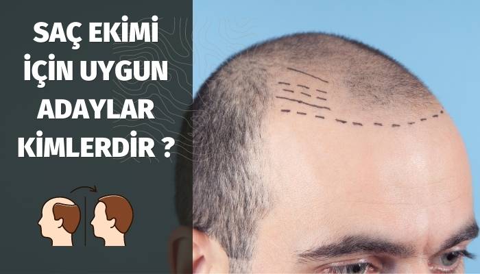 Saç Ekimi İçin Uygun Adaylar Kimlerdir ?