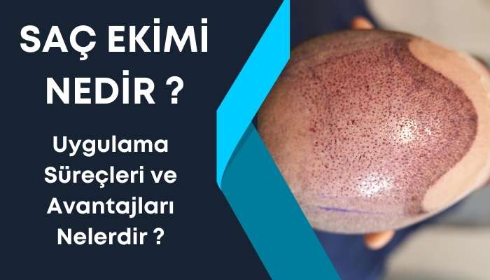 Saç Ekimi Nedir ?