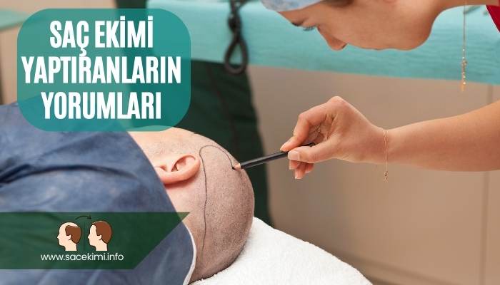 Saç Ekimi Yaptıranların Yorumları