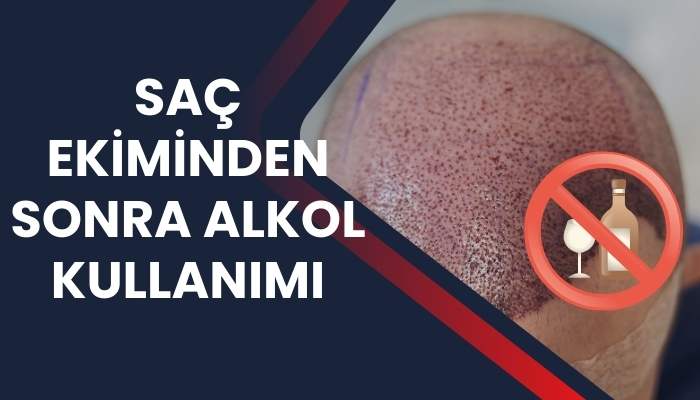 Saç Ekiminden Sonra Alkol Kullanımı