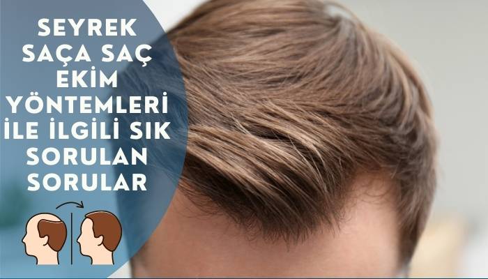 Seyrek Saça Saç Ekimi Yöntemleri: Sıkça Sorulan Sorular ve Cevaplar