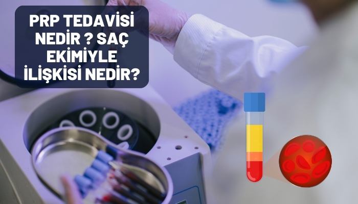 PRP Tedavisi Nedir ? Saç Ekimiyle İlişkisi Nedir?