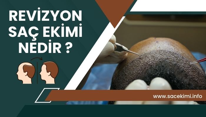 Revizyon Saç Ekimi Nedir?