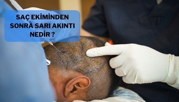 Saç Ekiminden Sonra Sarı Akıntı Nedir?