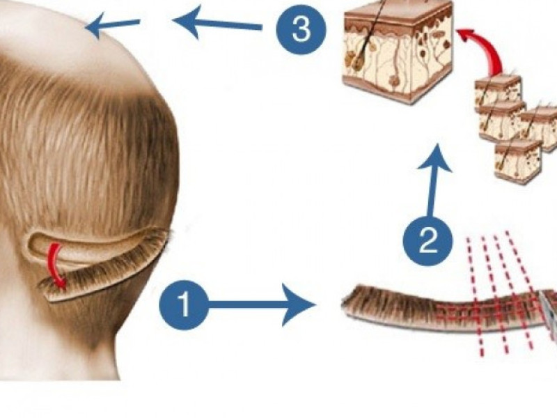 FUT Saç Ekim Yöntemi